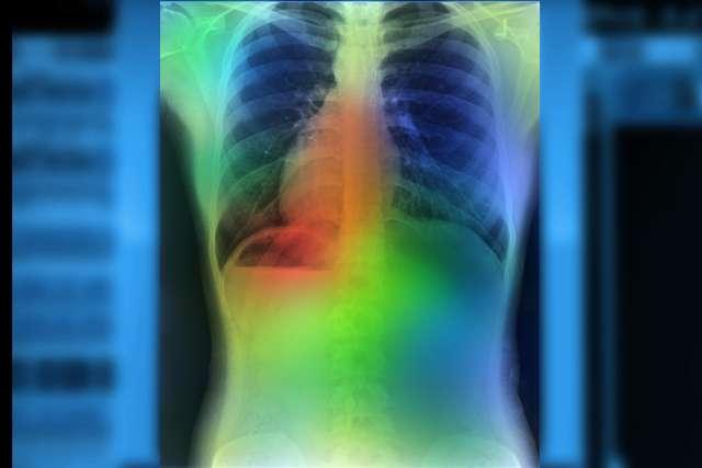 肺癌影像学