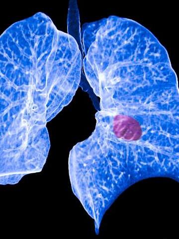 肺癌影像
