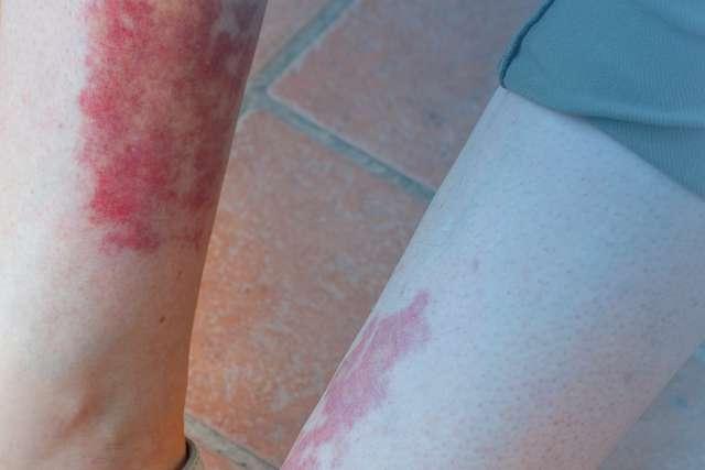 Leukocytoclastic vasculitis, an inflammatory reaction in the blood vessels appearing on woman's leg